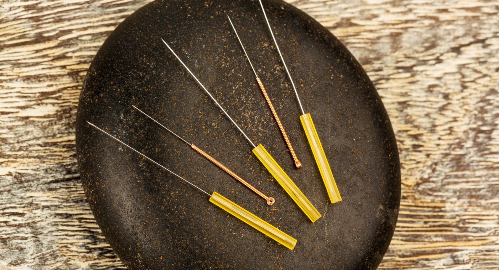 Acupuncture for Complex Regilonal Pain Syndrome (CRPS)