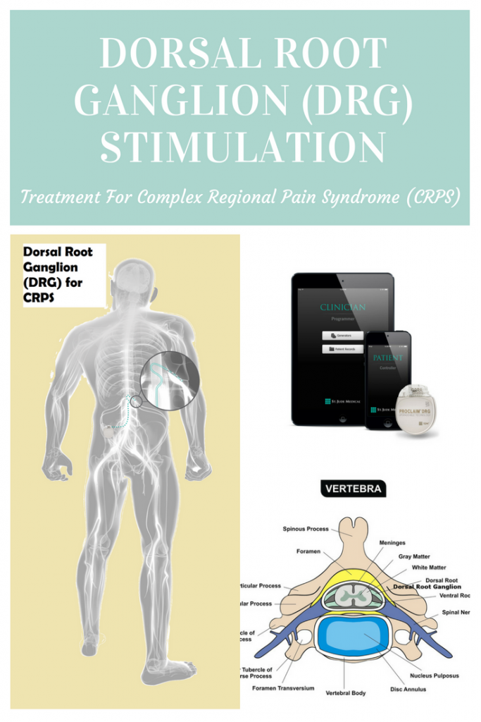 Pros and Cons of Spinal Cord Stimulators - Gainsberg Law